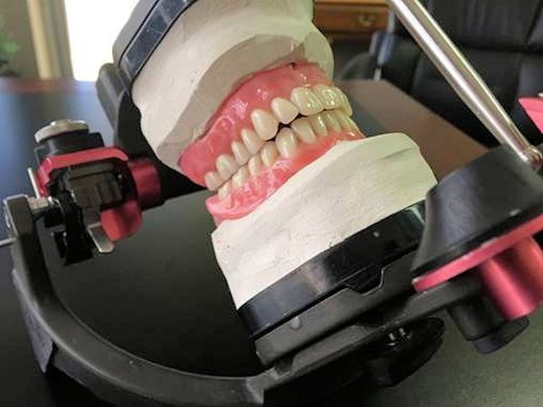 Image of Bite Registration Determination