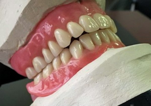 Image of Customized Wax Denture Set-Up