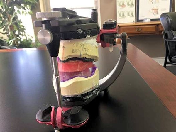 Image of Facebow Transfer