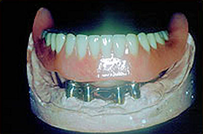 Image of seated denture implant