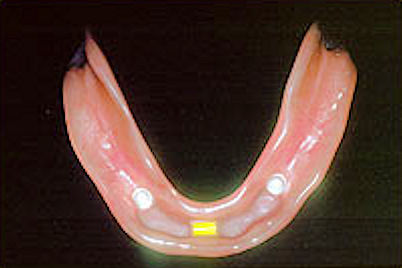 Image of denture implant showing clip