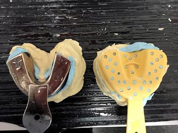 Image of Preliminary Denture Impression